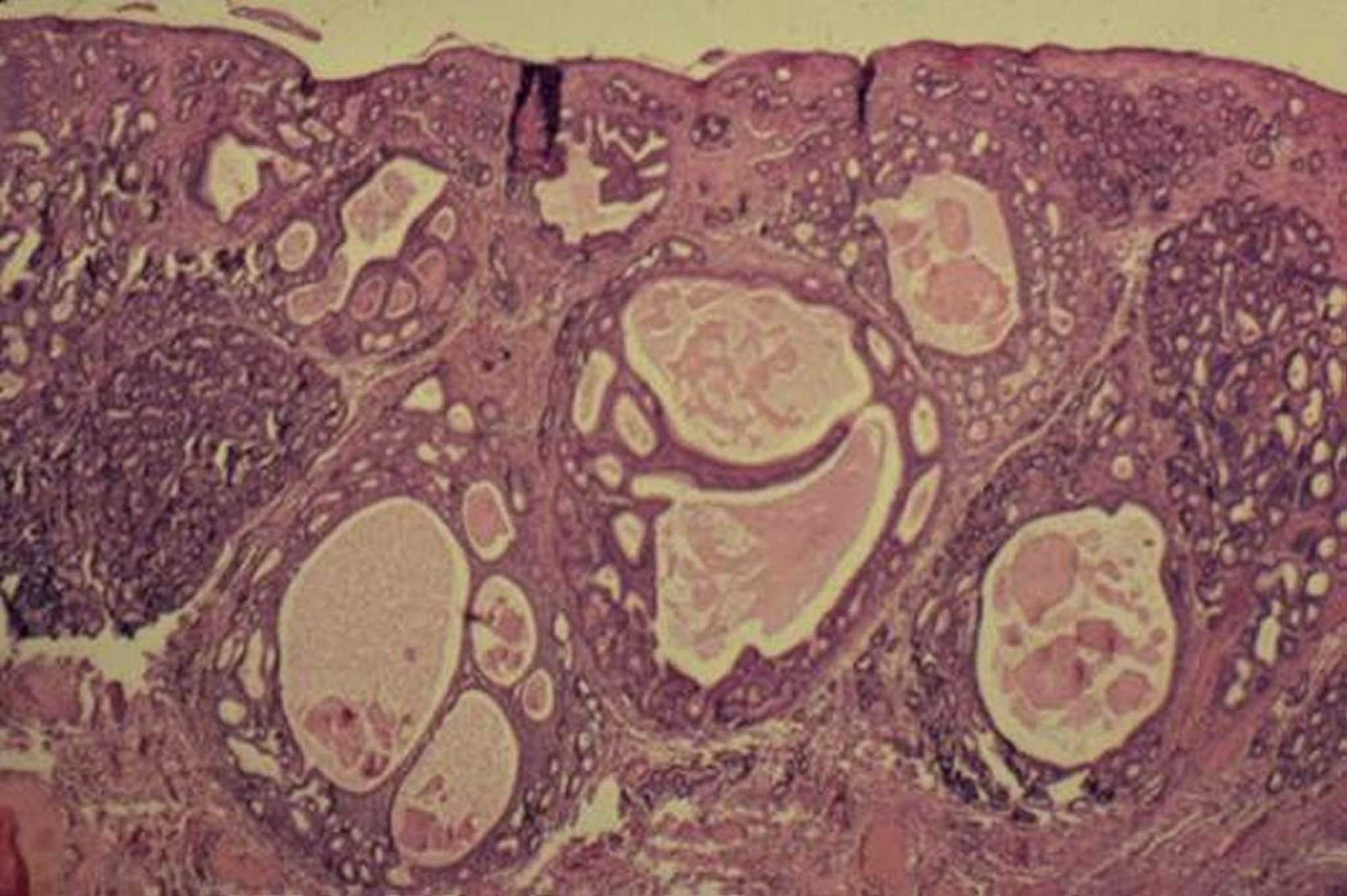 Fibrosis periglandular grave y distensión glandular quística, histopatología, yegua