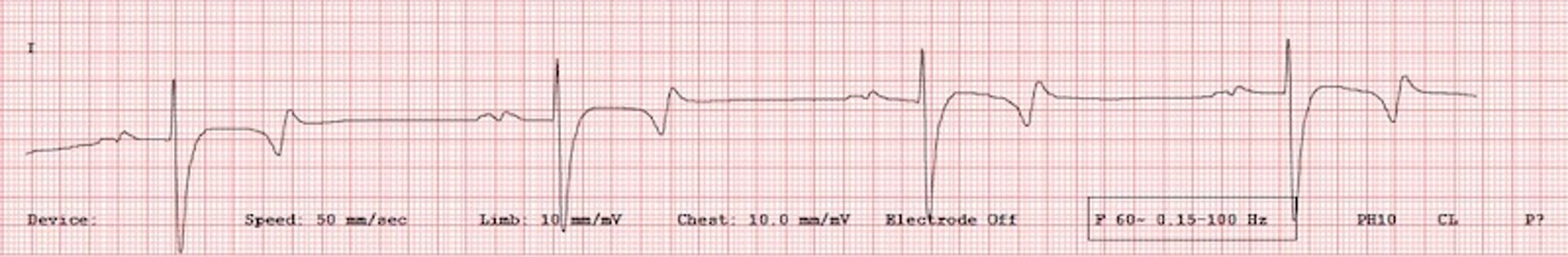 Ritmo sinusal, ECG, cavalo