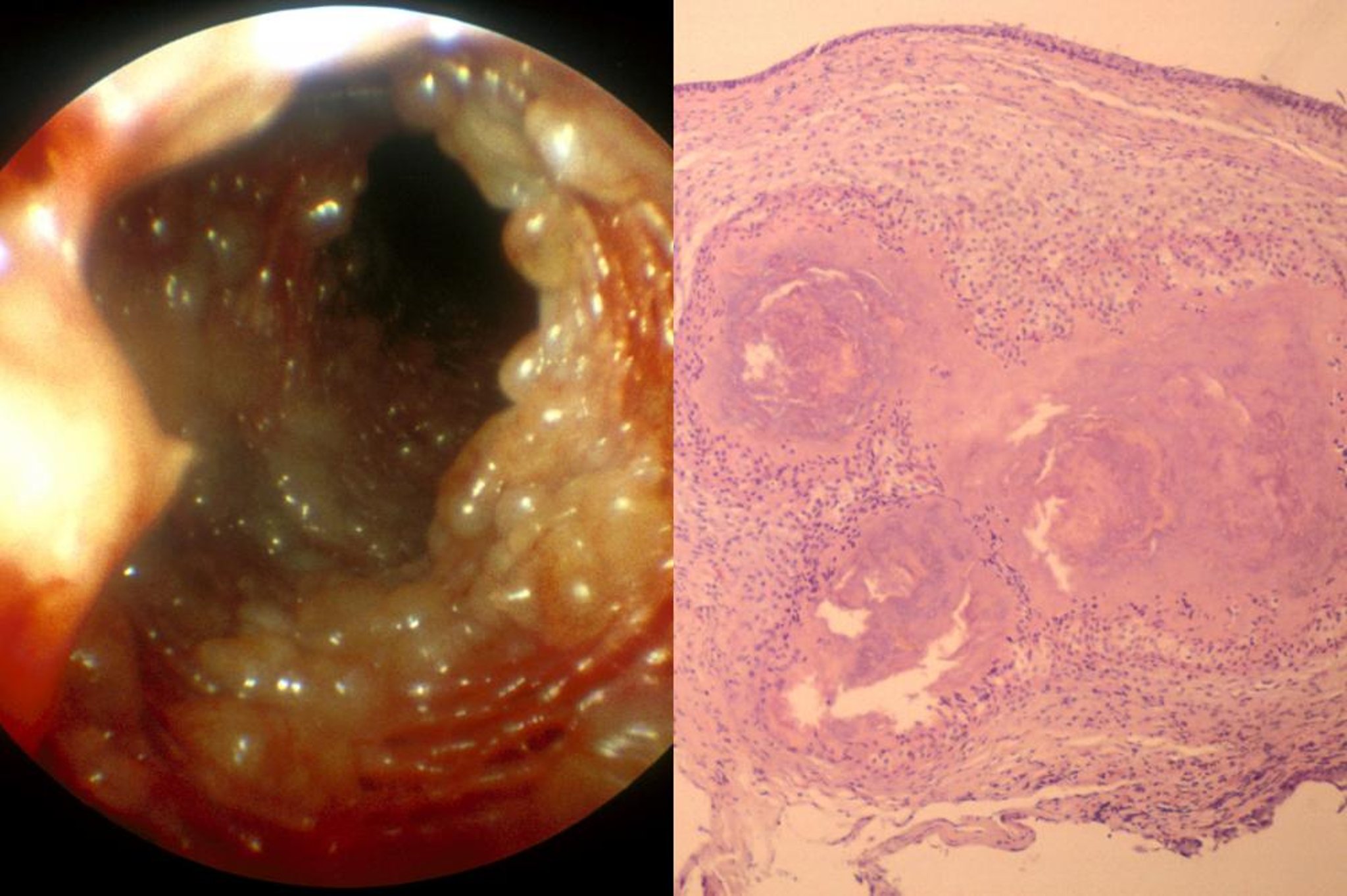 Micobacteriosis pulmonar, pitón bola