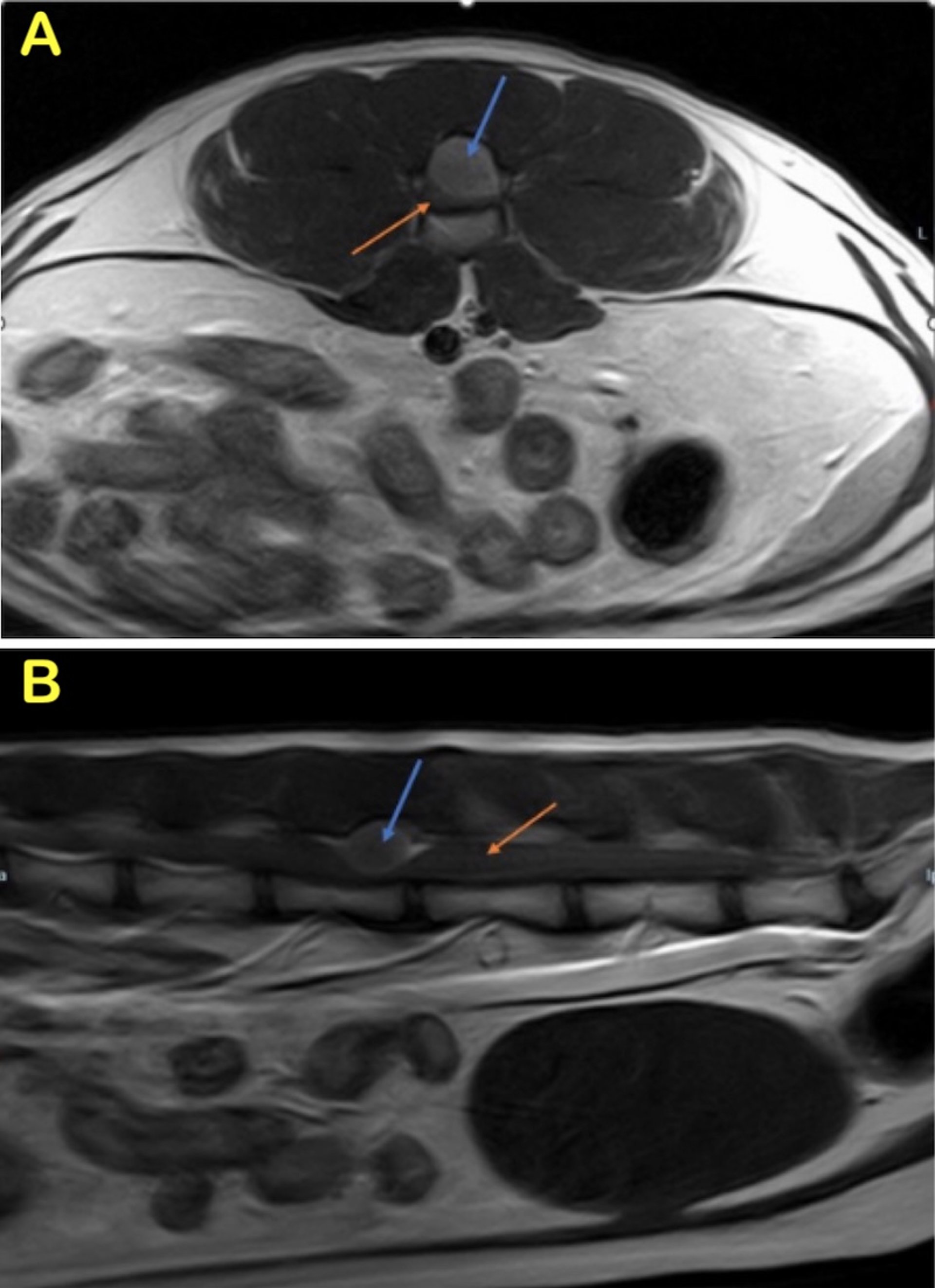Spinal meningioma, MRI, cat