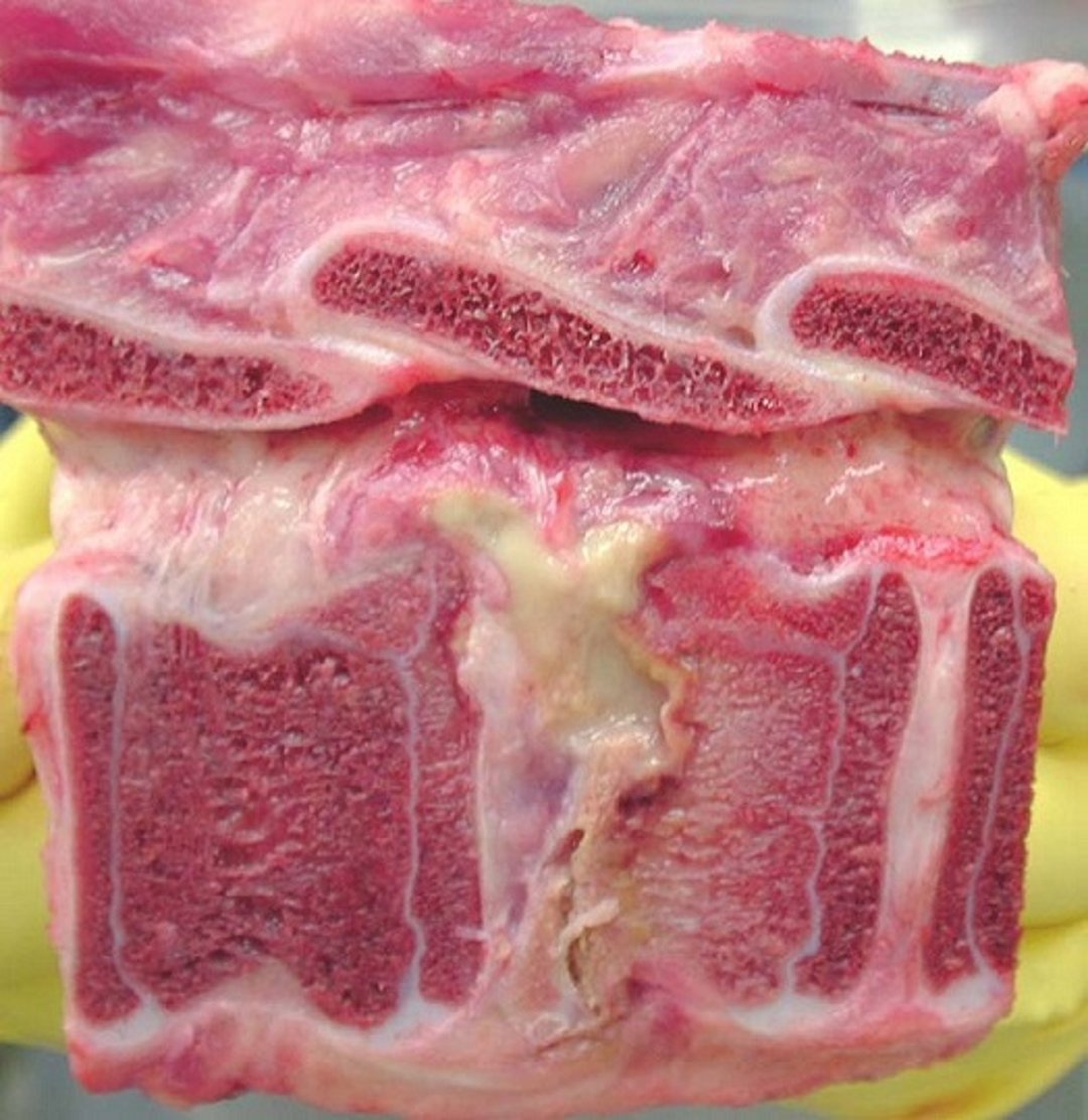 Absceso del cuerpo vertebral espinal