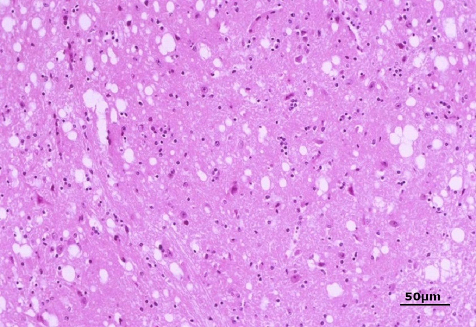 Espongiose na encefalopatia espongiforme bovina