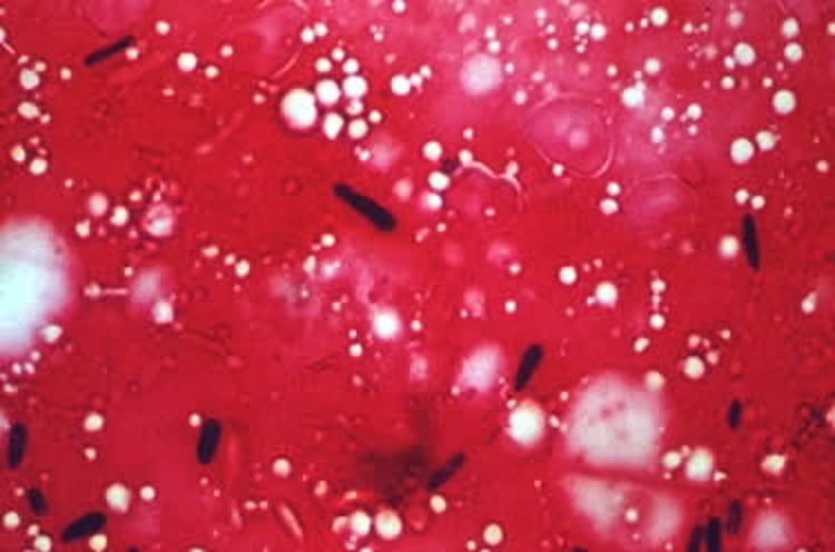 <i >Sporothrix schenckii</i>, frotis de tejido