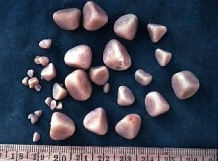 Struvite calculi removed from bladder