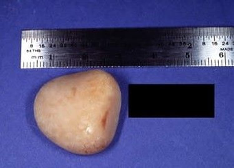 Struvite stone, dog