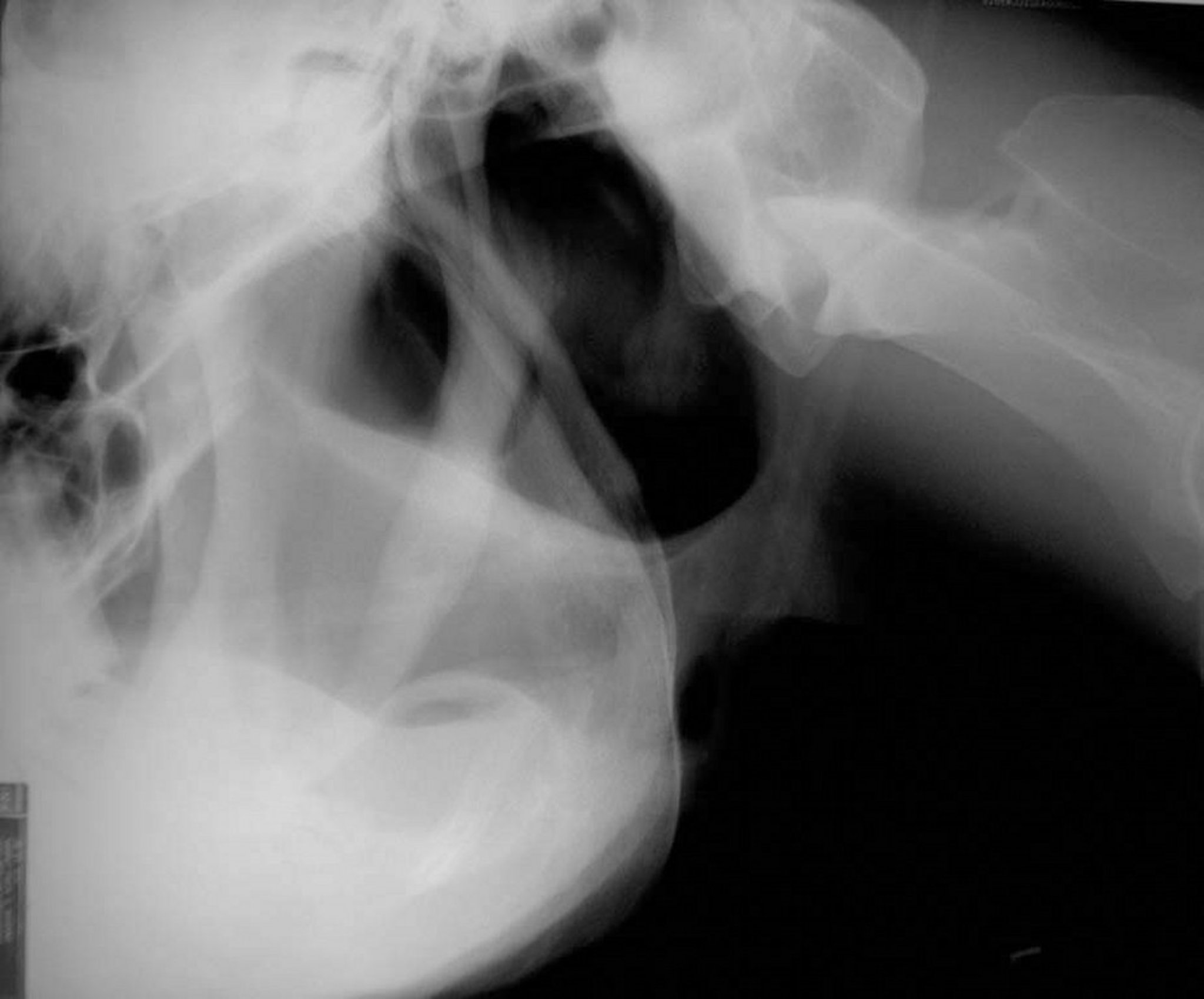 Fractura estilohioidea, caballo