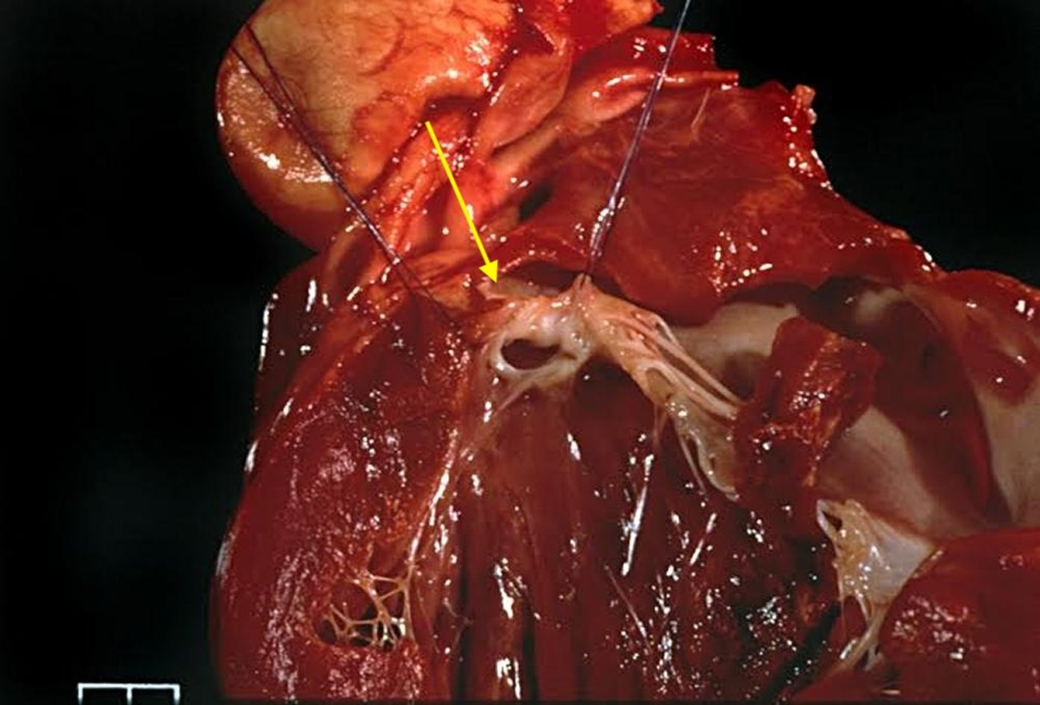 Subaortic stenosis, dog