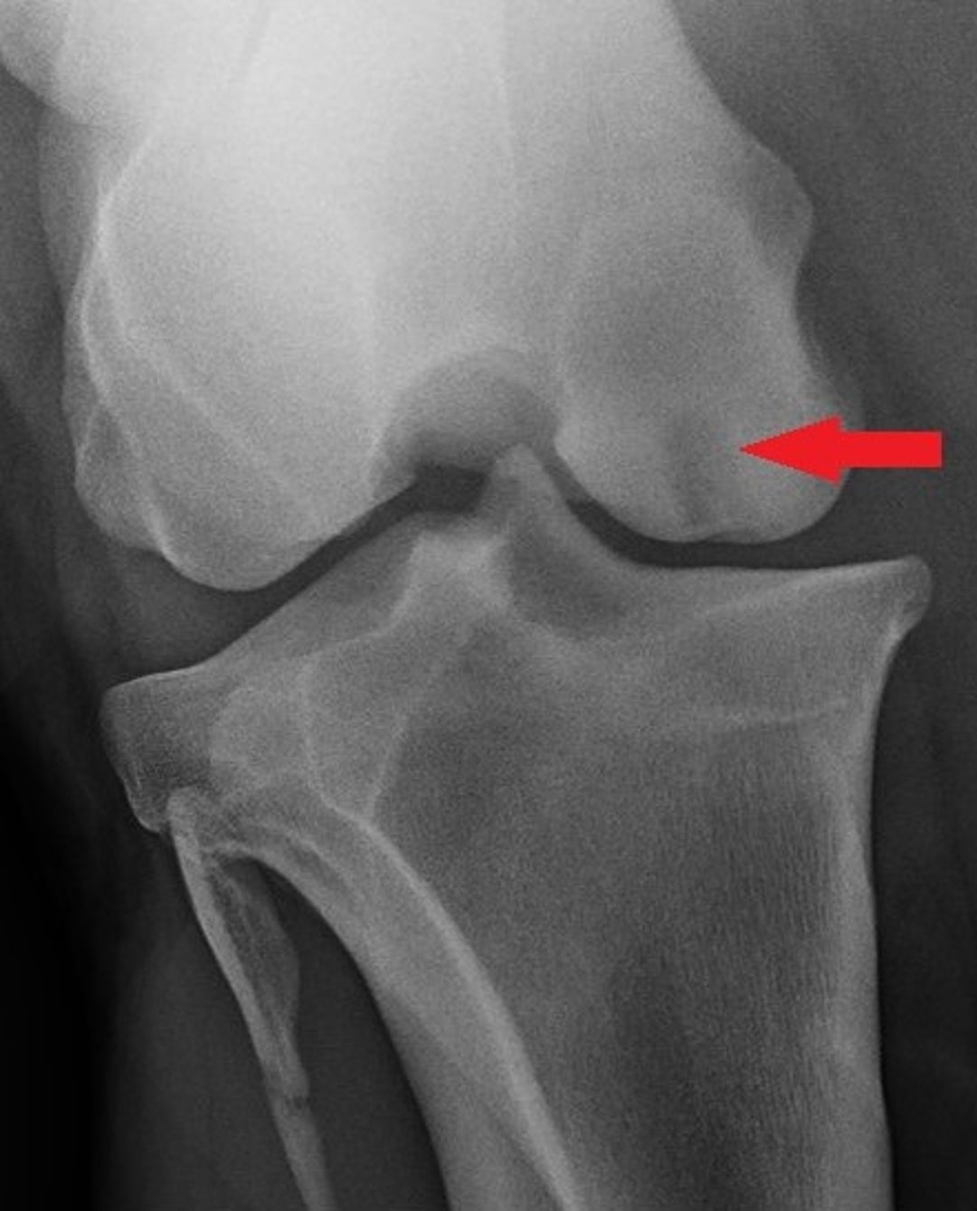 Subchondral bone cyst, stifle, radiograph, horse