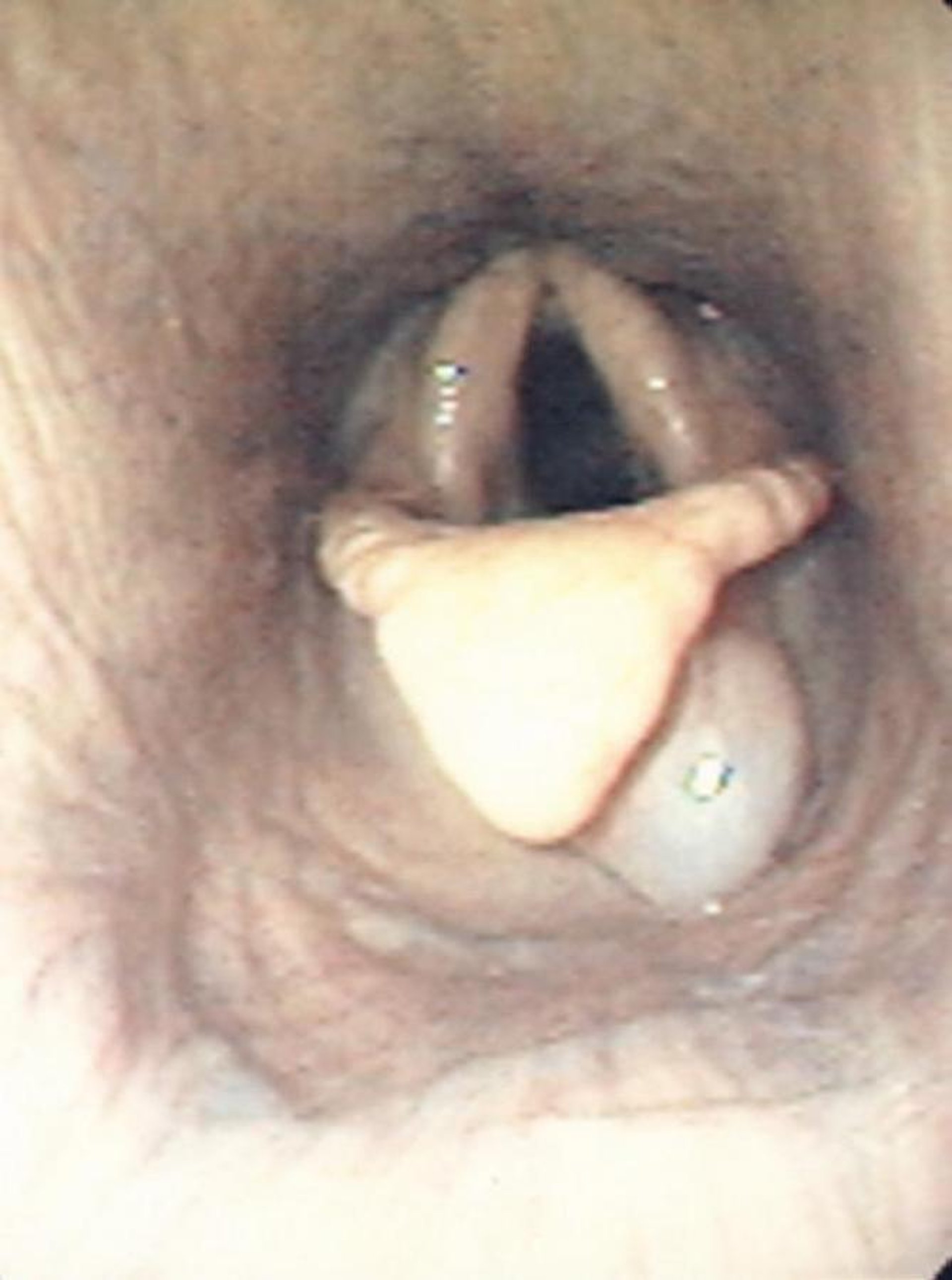 Subepiglottic cyst, horse