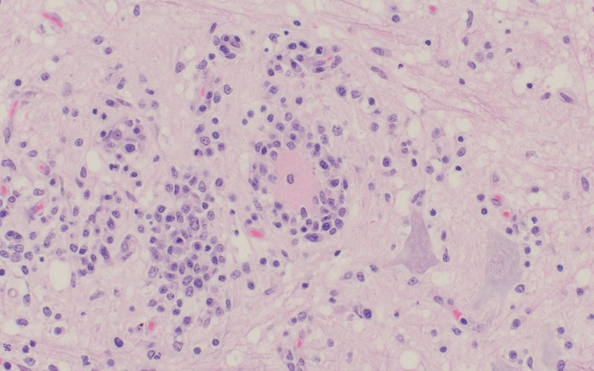 Teschovirus encephalomyelitis, neuronal necrosis and satellitosis