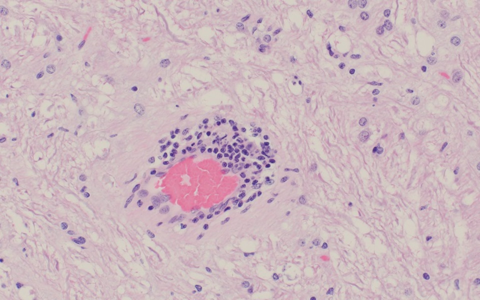 Teschovirus encephalomyelitis, perivascular cuffing