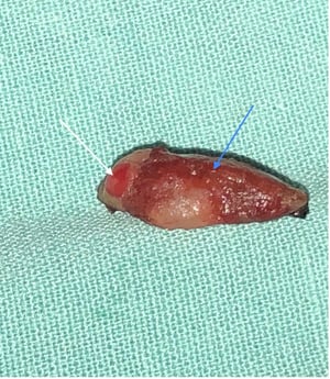 Excised thyroid and parathyroid, dog