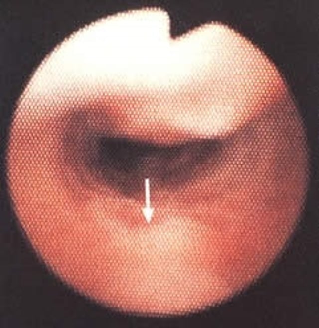 Tracheal collapse, dog