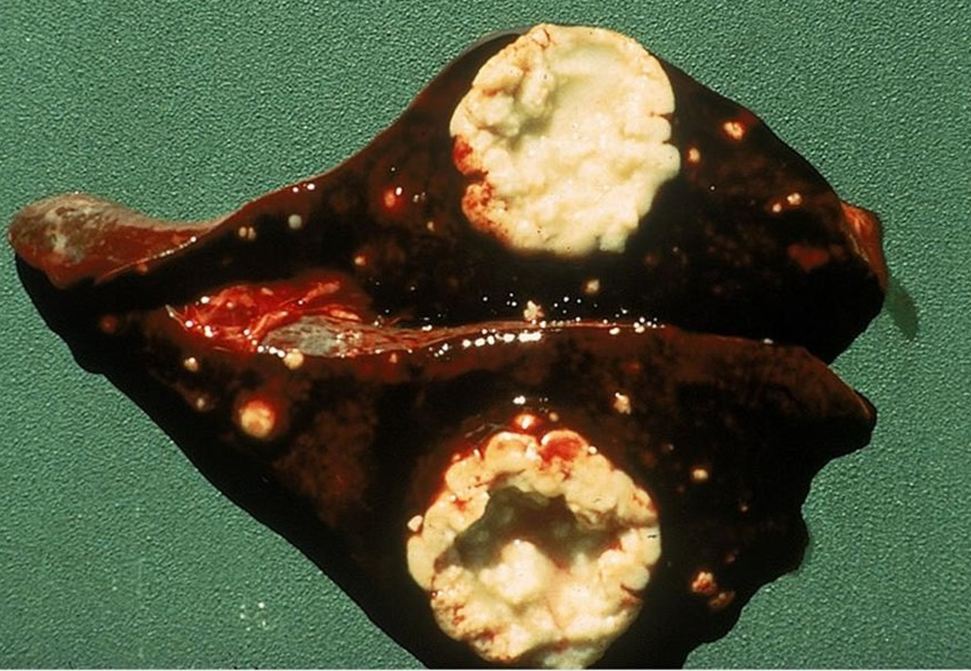 Tuberculous lesions, liver, nonhuman primate