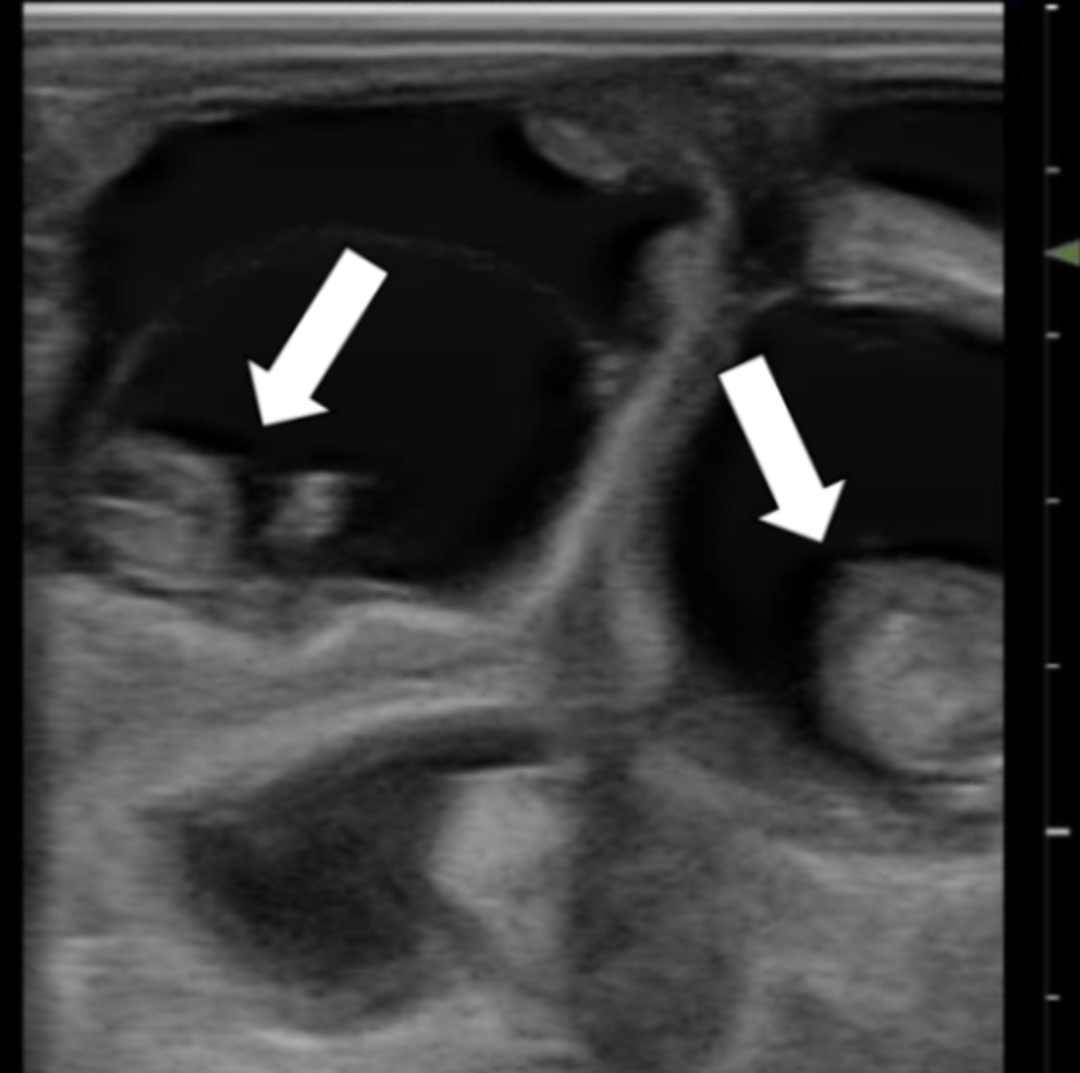 Twin pregnancy, goat (ultrasonography)