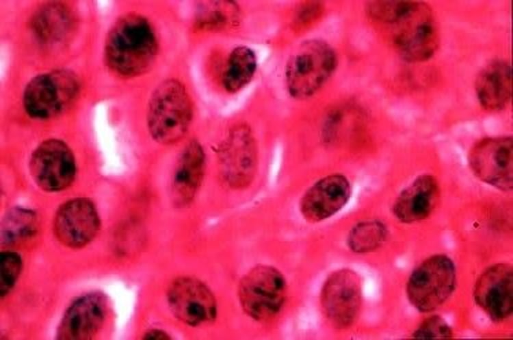Transitional cell carcinoma, bladder, histological image, dog