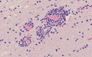 Encefalomielitis por teschovirus con gliosis y manguito perivascular