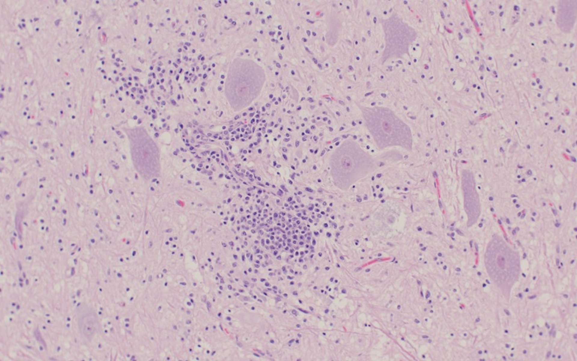 Encefalomielitis por teschovirus, gliosis y manguito perivascular