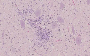 Encefalomielitis por teschovirus, gliosis y manguito perivascular