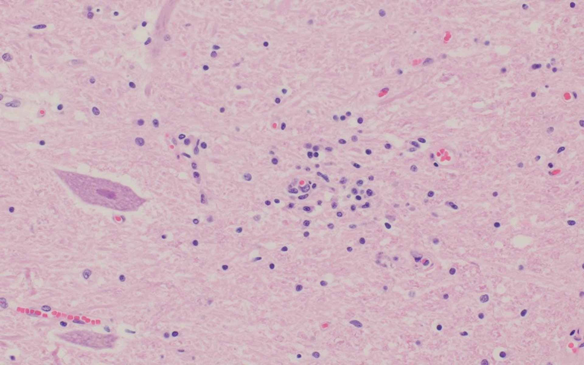 Encefalomielitis por teschovirus, necrosis neuronal
