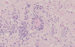 Encefalomielitis por teschovirus, necrosis neuronal y satelitosis