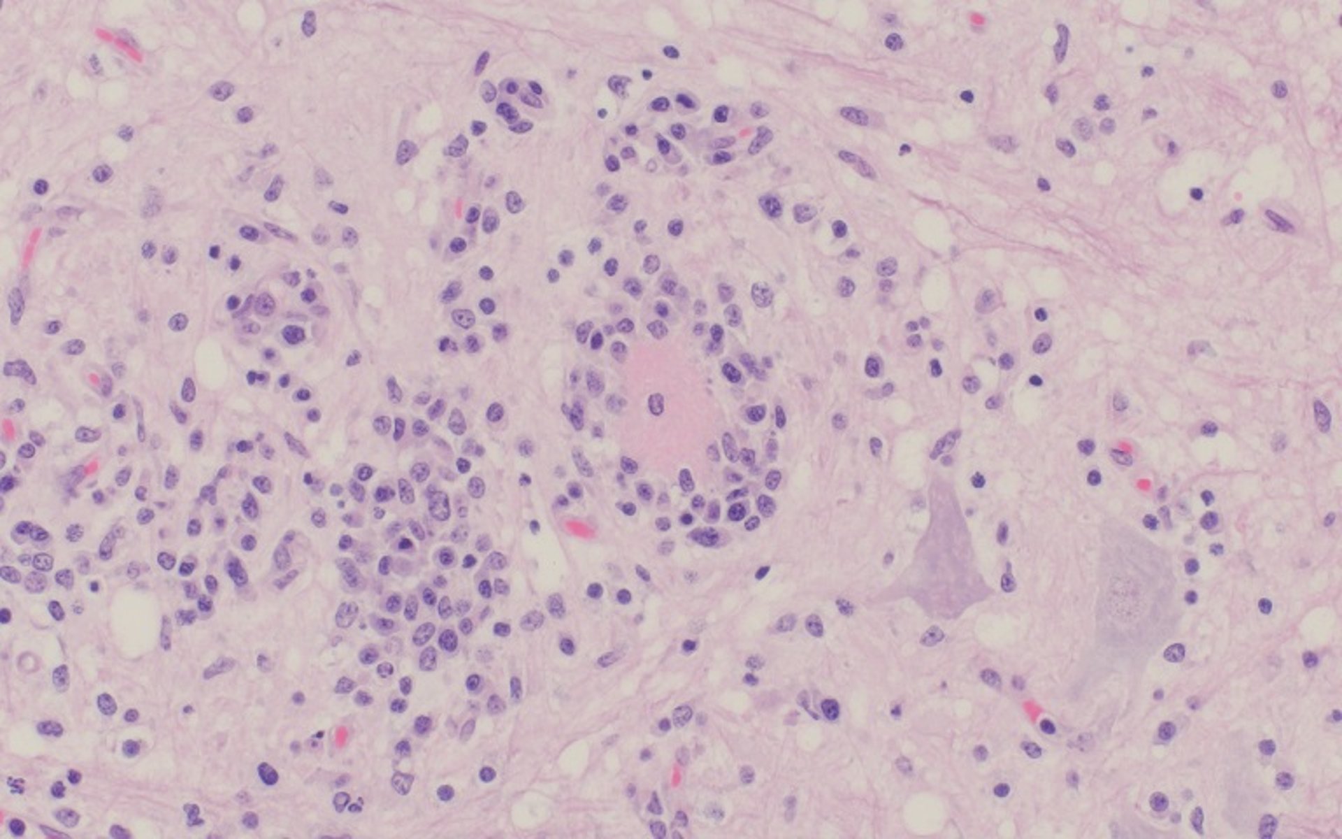 Encefalomielite por teschovírus, necrose neuronal e satelitose