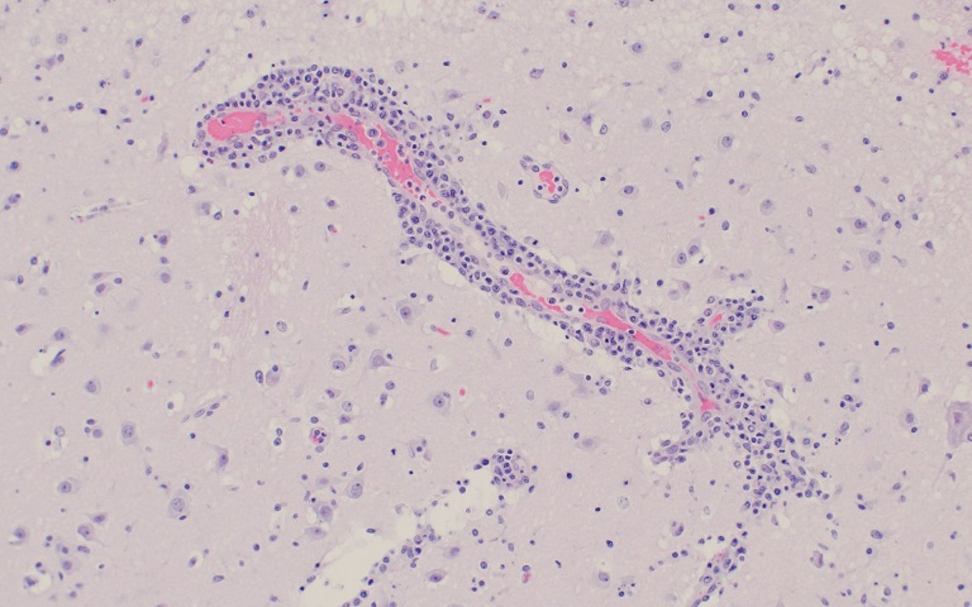 Encefalomielitis por teschovirus, manguito mononuclear perivascular