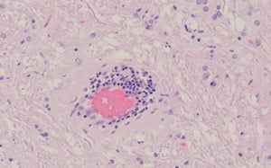 Encefalomielitis por teschovirus, manguito perivascular