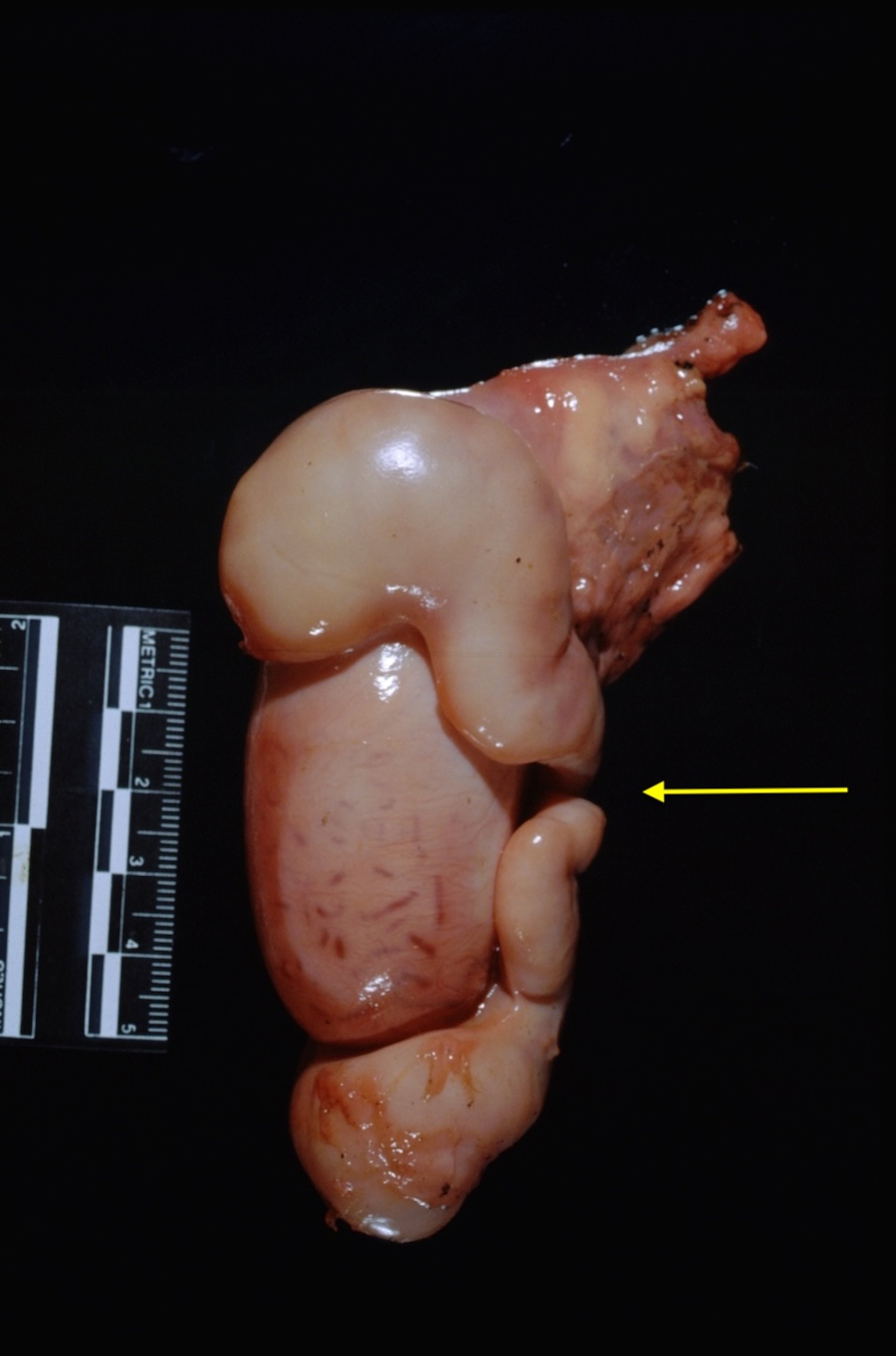 Segmental aplasia of the epididymis, bull