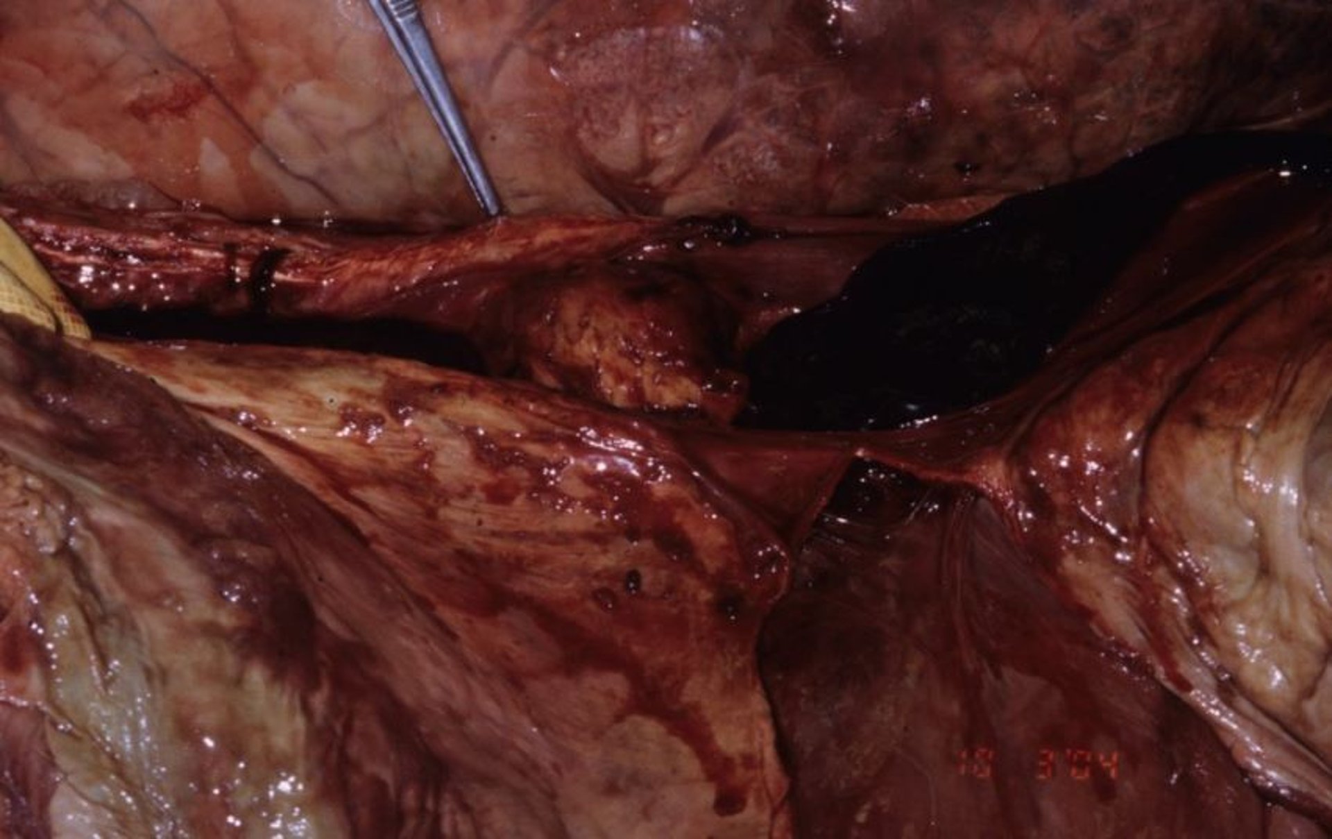Thrombosis of the caudal vena cava, bovid