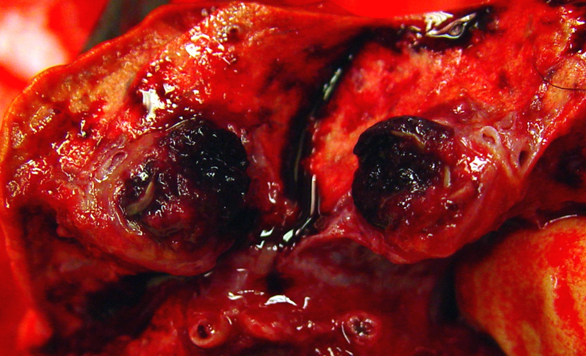 Trombo, arteria pulmonar, perro