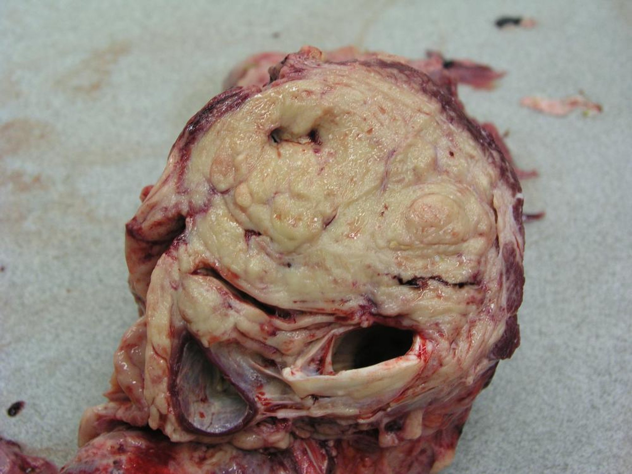 Linfossarcoma tímico