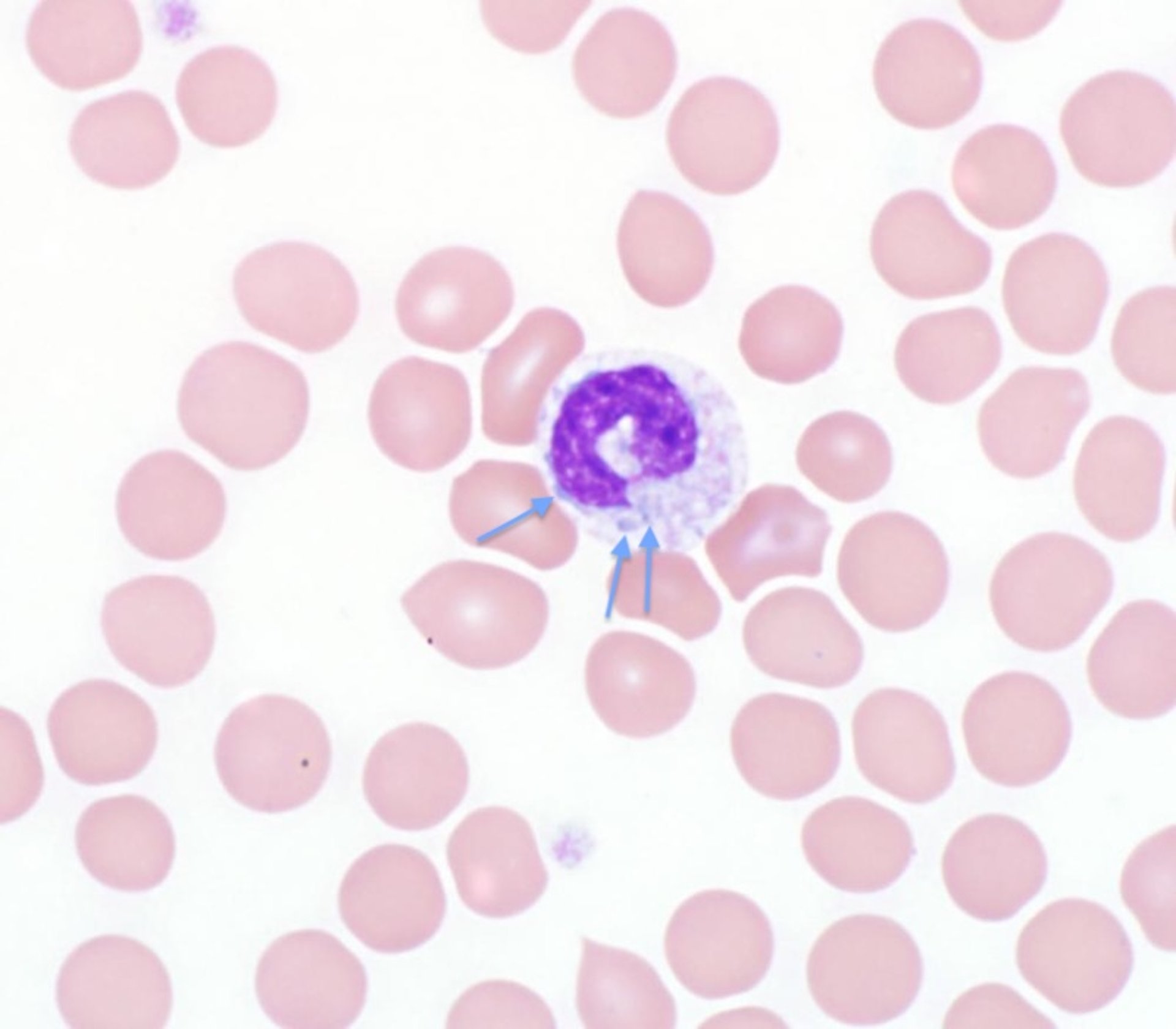 Toxic neutrophil, blood smear, dog