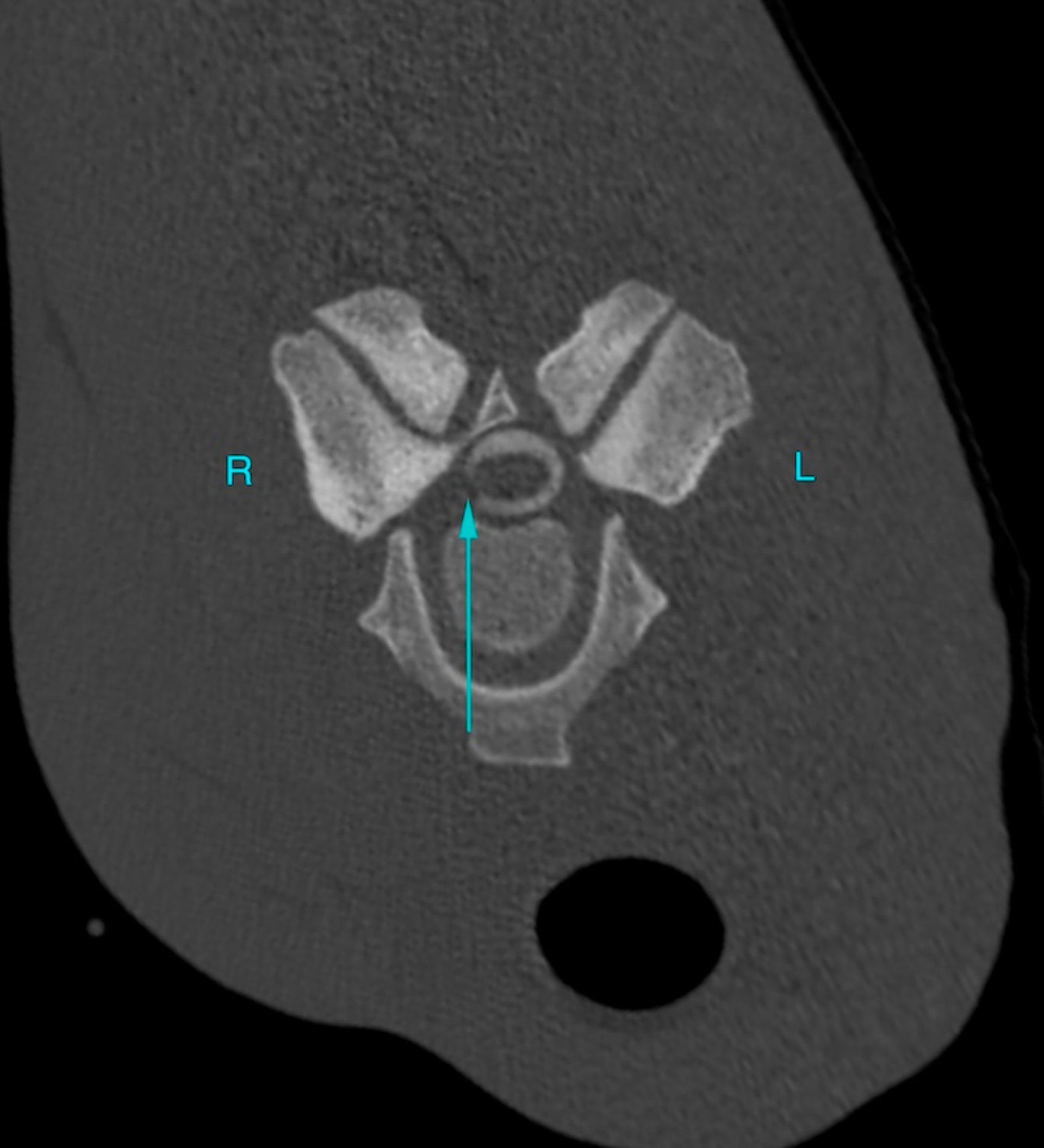 Transverse CT, myelogram, cervical vertebral column, horse