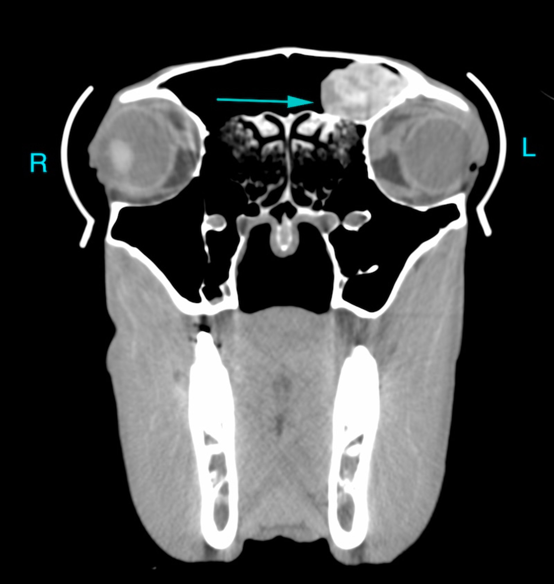 TC transversal, cráneo, hematoma etmoidal, caballo