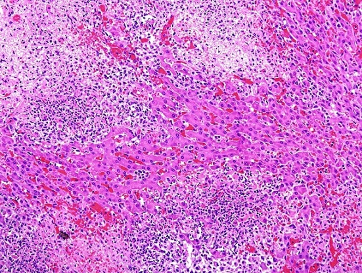 Tyzzer disease, hepatic necrosis, foal, photomicrograph