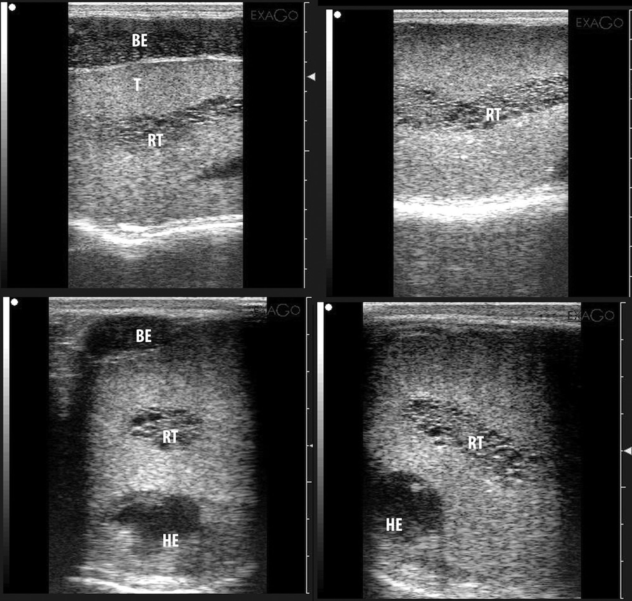 Rete testis cyst, ram