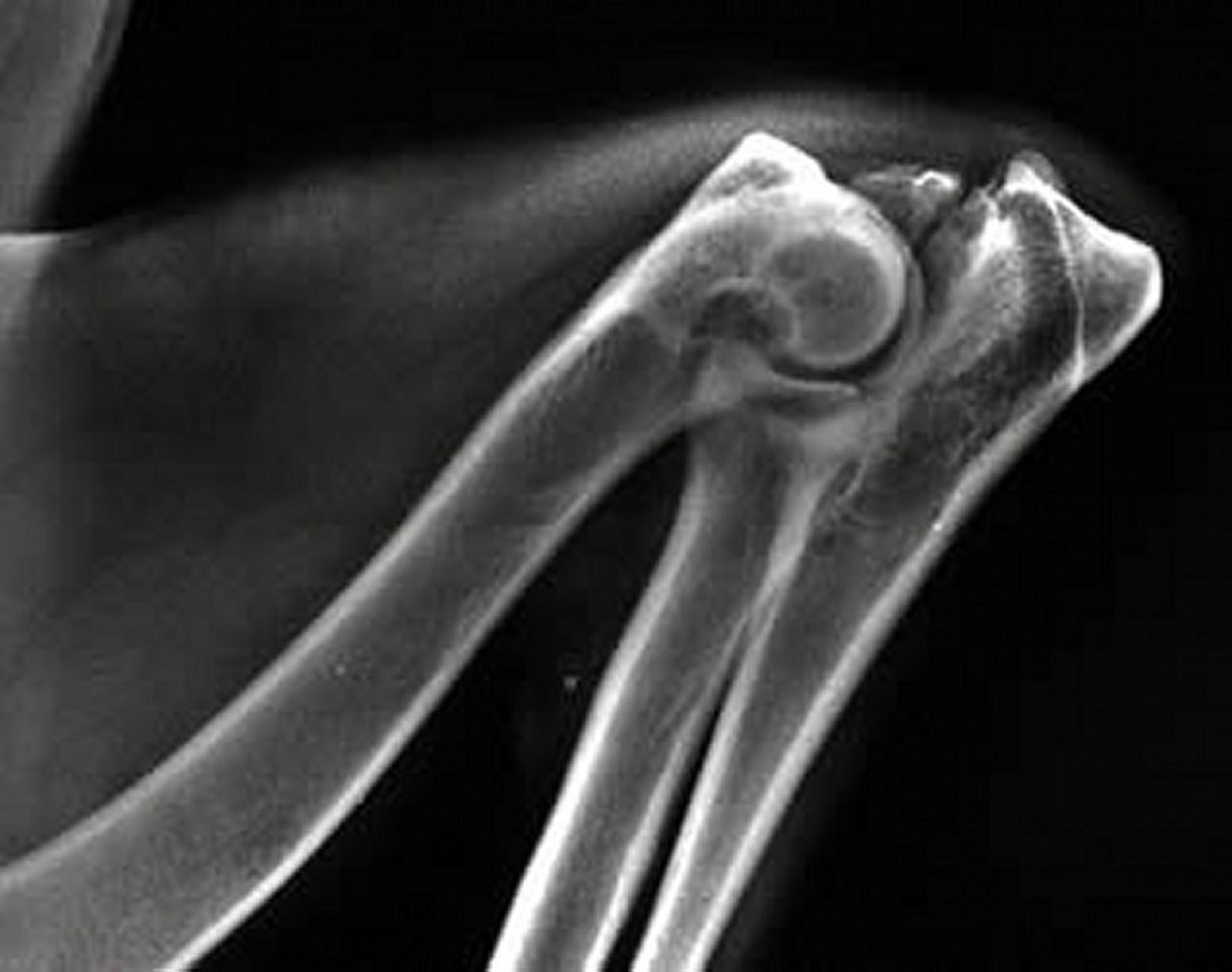 Ununited anconeal process