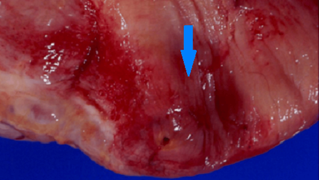 Urinary bladder hemorrhage, bovine
