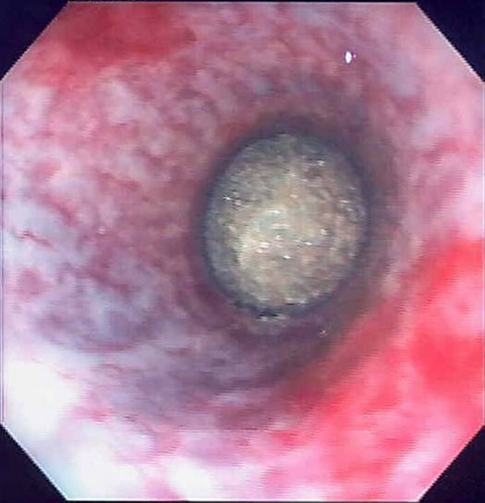 Urolithiasis, stallion (endoscopy)
