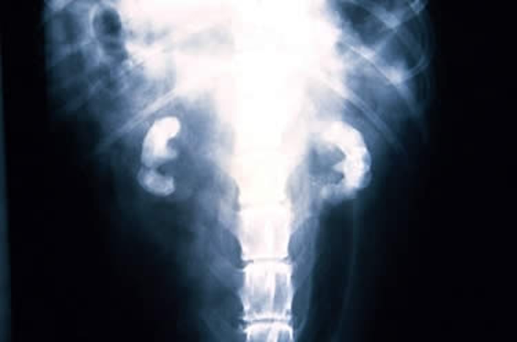 Renal calculi, radiograph