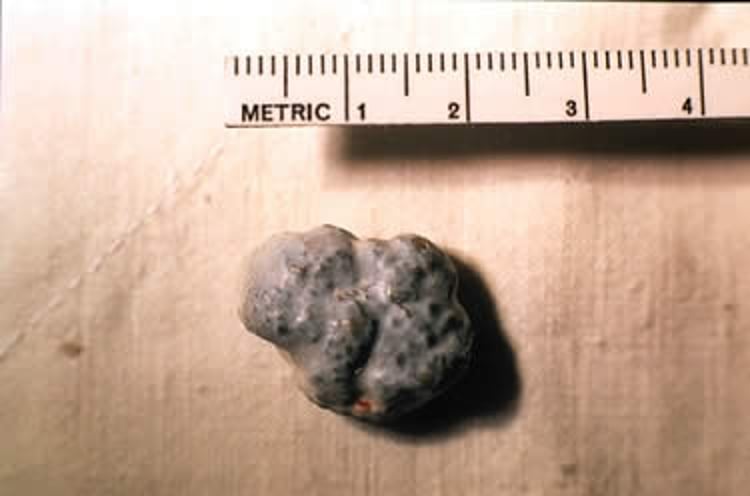 Image:urate Bladder Stones, Dalmatian-merck Veterinary Manual