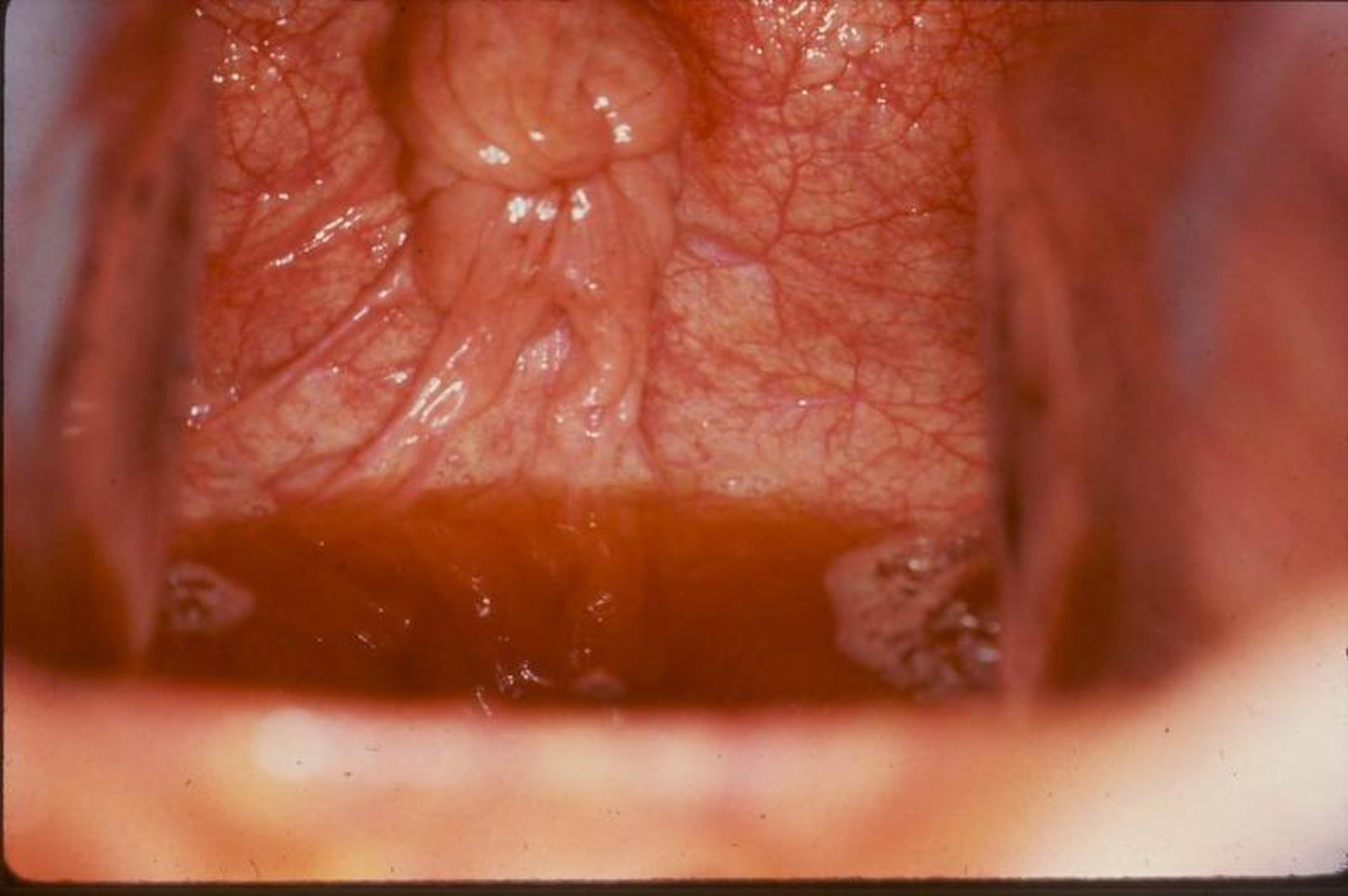 Urovagina, mare
