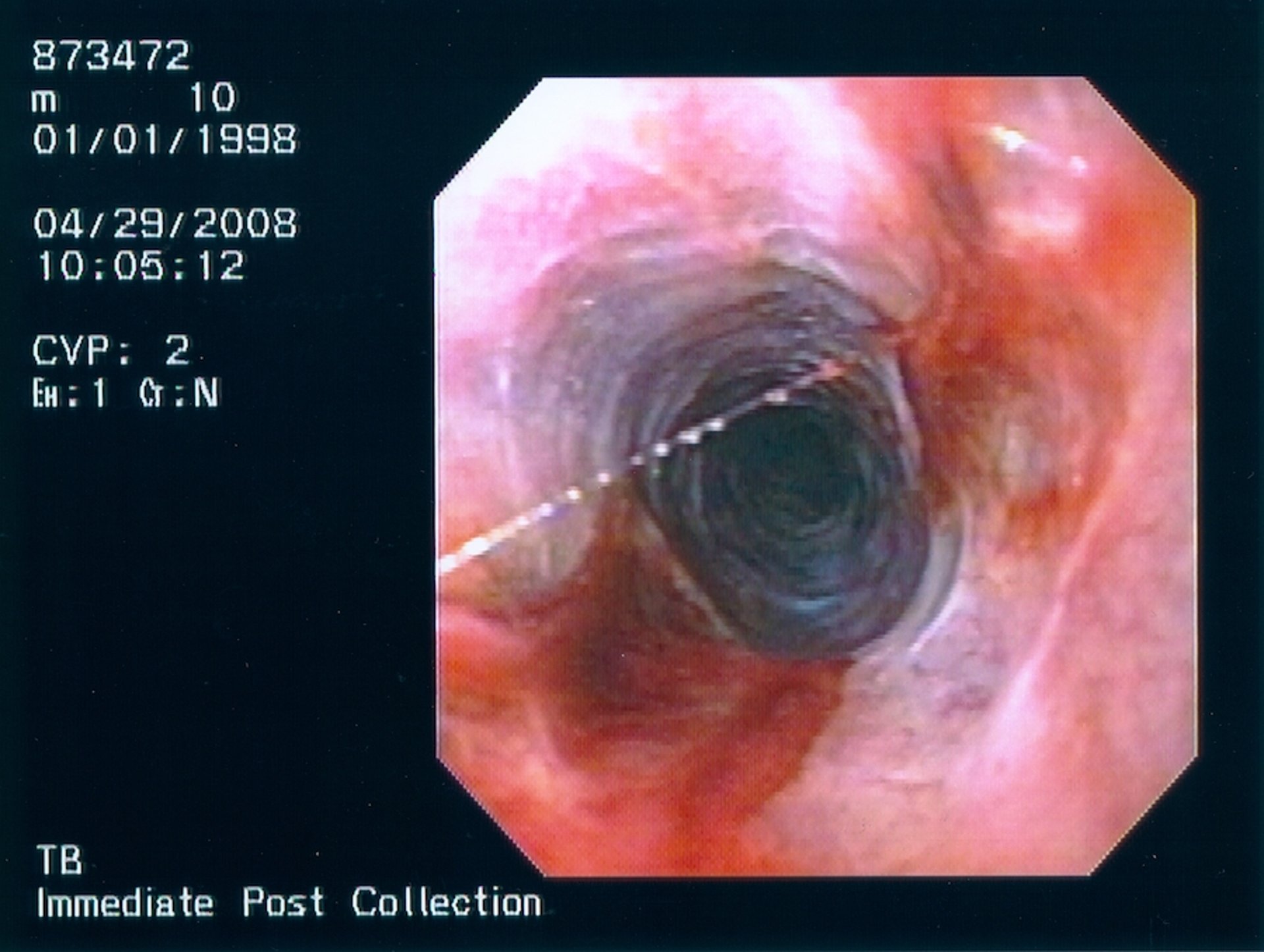 Hemospermia, urethroscopy, stallion