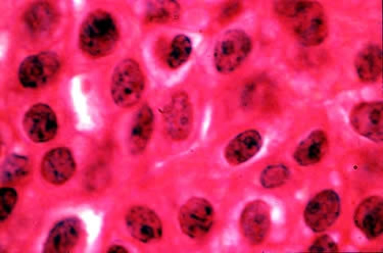 Carcinoma de células de transición, vejiga canina, histopatología