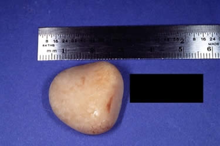 Piedra de estruvita
