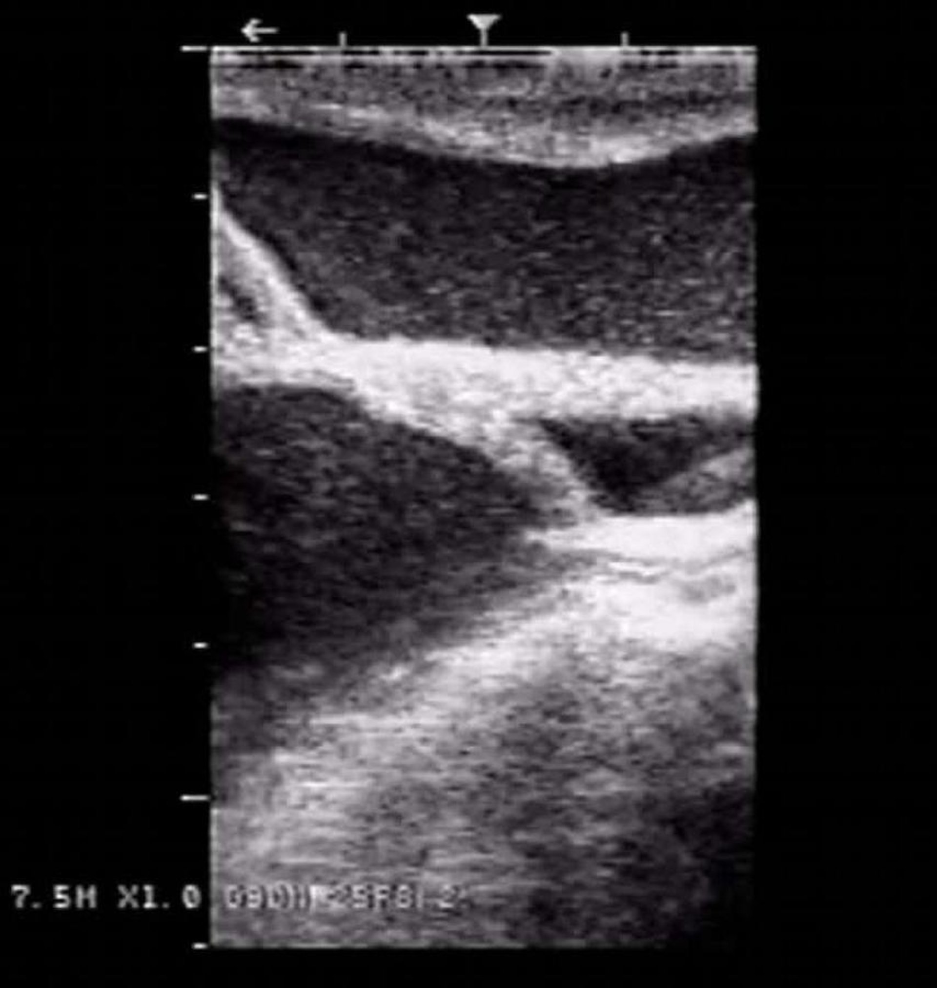 Vaginal aplasia, alpaca