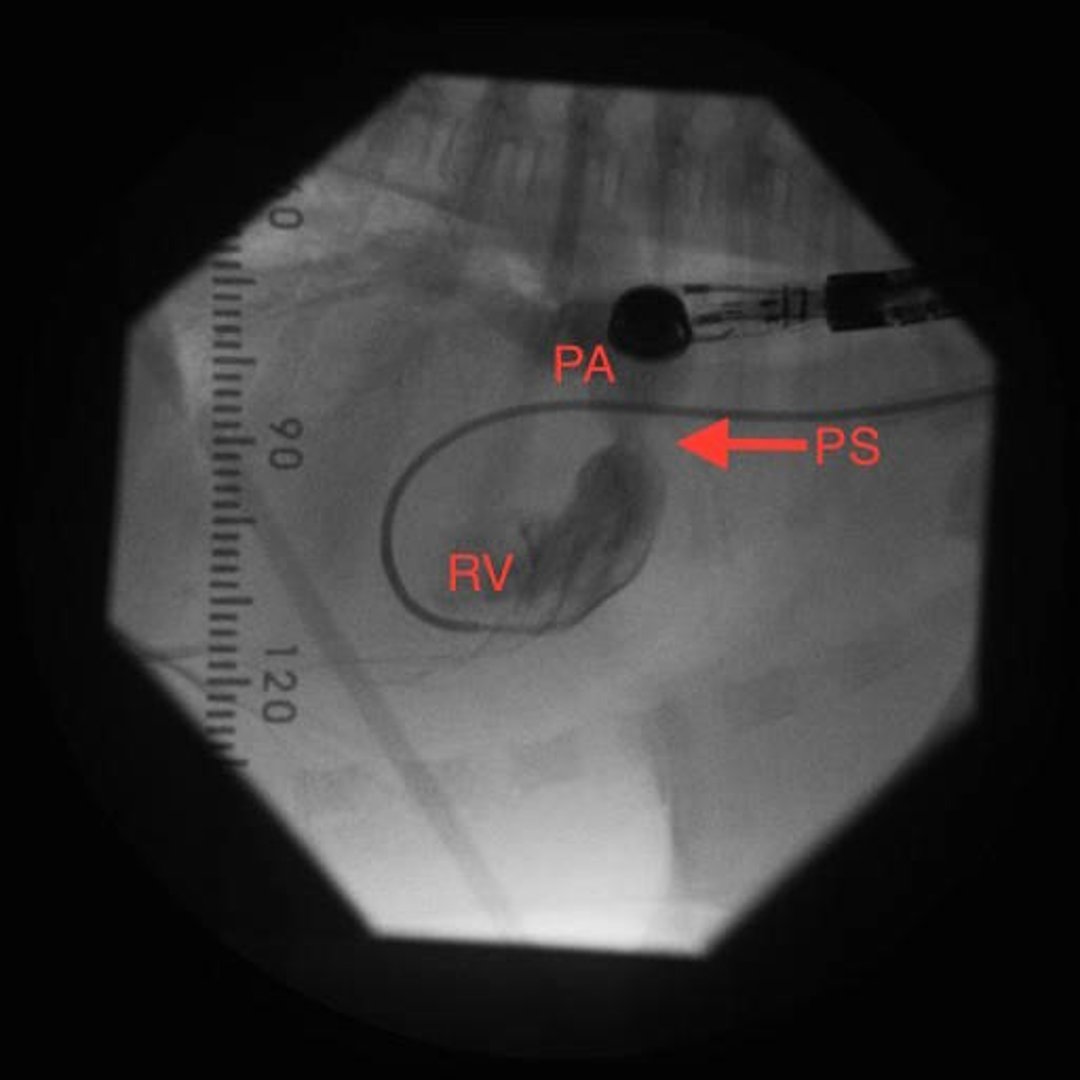 Estenosis pulmonar valvular, angiografía, perro