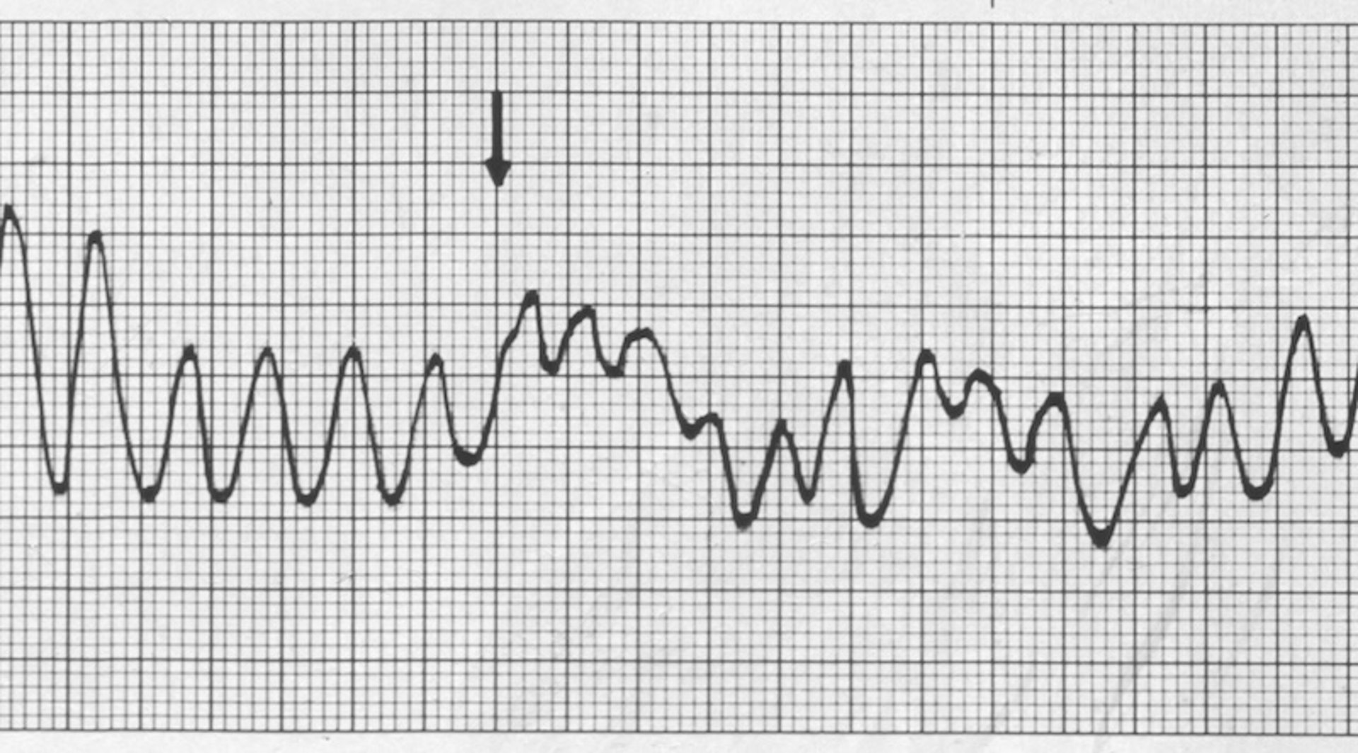 Ventricularfibrillation, ECG tracing
