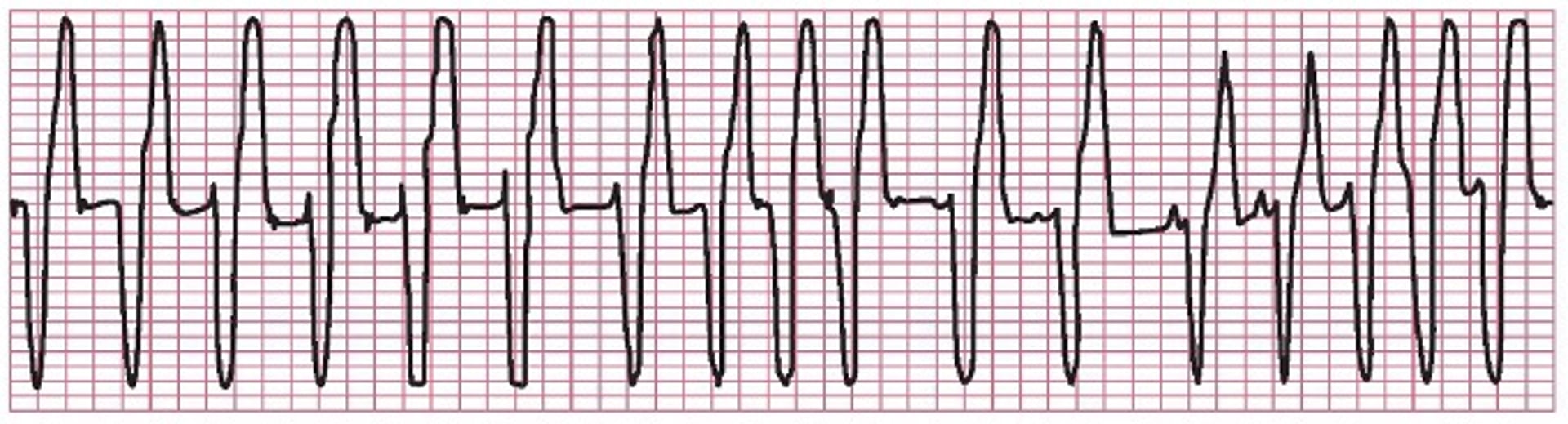 Taquicardia ventricular, traçado de ECG